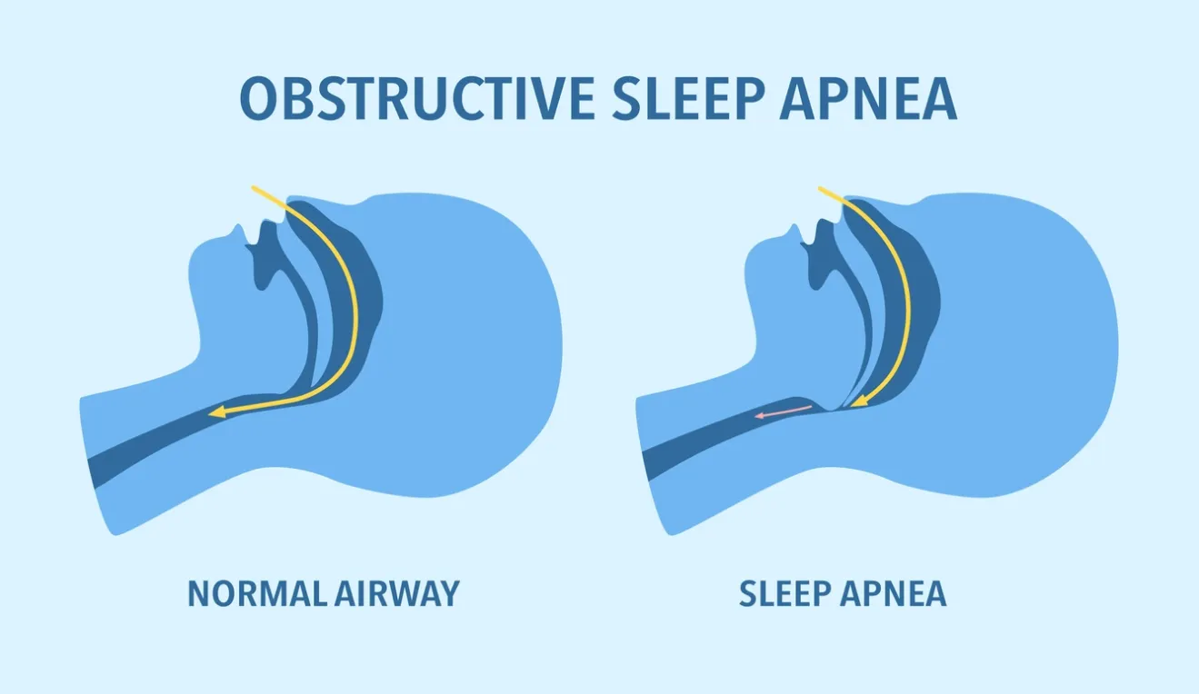Could Sleep Apnea Be Affecting You?