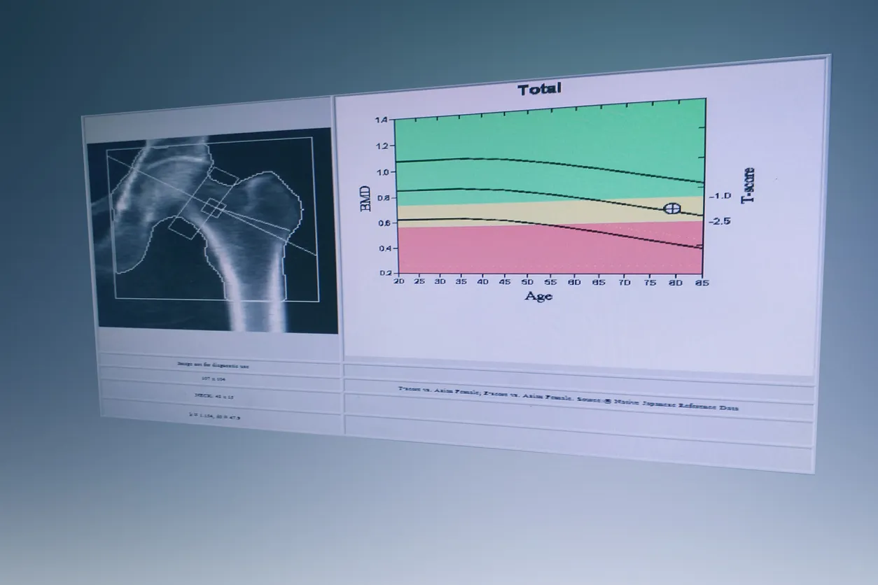 A bone density (DEXA) scan readout showing a hip image and a chart of bone mineral density plotted against age.